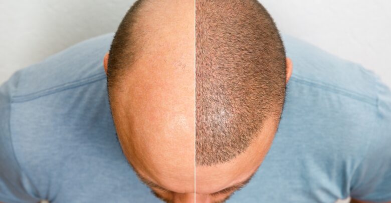 The,Head,Of,A,Balding,Man,Before,And,After,Hair